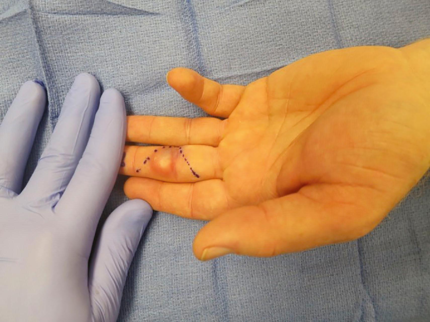 Figure 16.5, Epidermal inclusion cyst of the volar finger skin before excision. These masses, which originate from an invagination of epithelium, can follow trauma, injection, or an incision. The epithelium is internalized, resulting in subcutaneous keratin deposition.