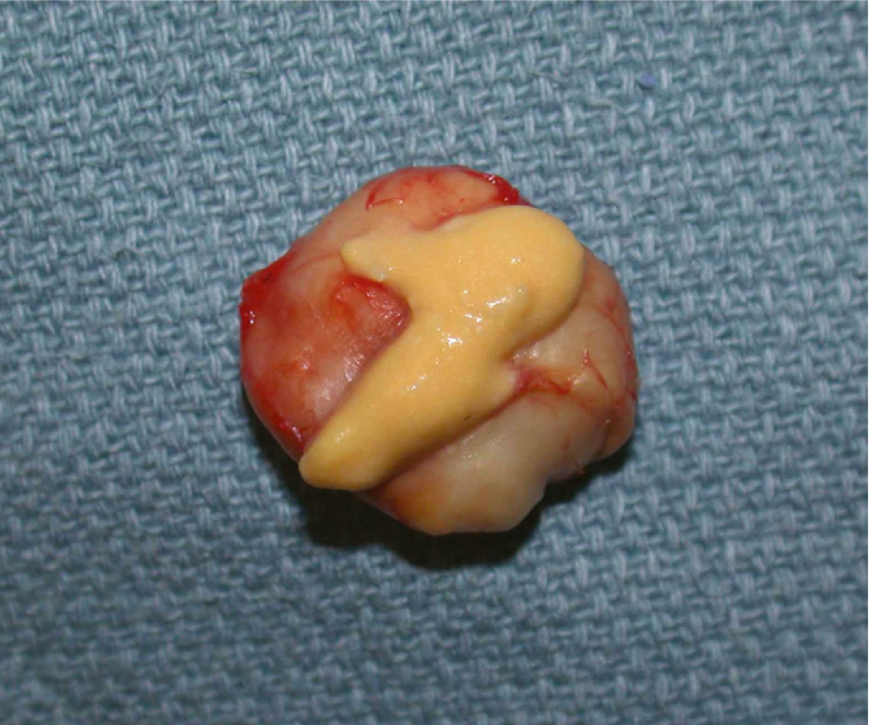 Figure 16.7, Sebaceous cyst. These pseudotumors arise from an obstructed apocrine gland, which produces sebum as opposed to keratin.