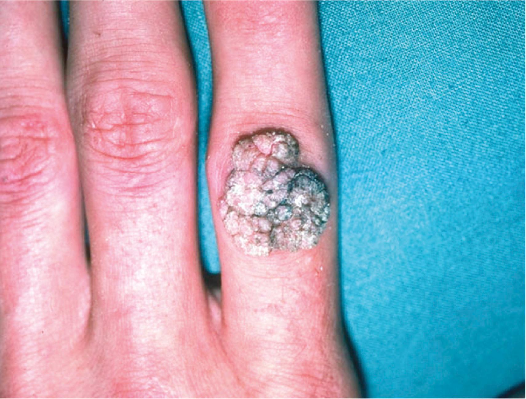 Figure 16.8, Verruca vulgaris. This lesion presents as a rough raised surface commonly on the dorsum of the hand.