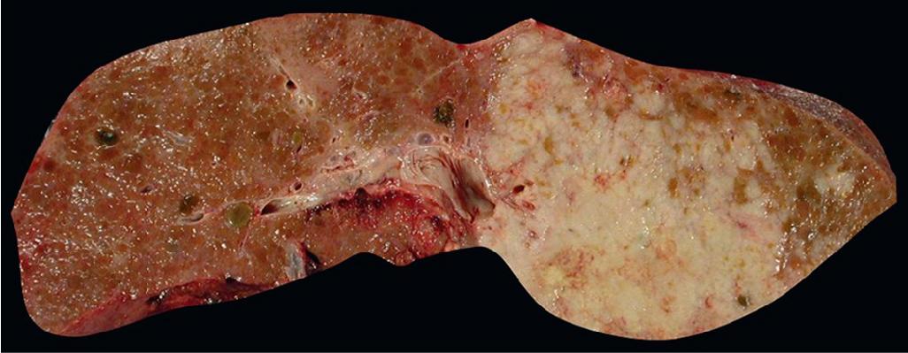 FIGURE 87.4, Hepatocellular carcinoma with an infiltrative growth pattern.