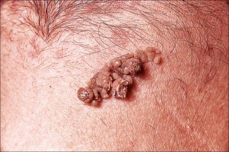 Fig. 24.1, Epidermal nevus: this fairly typical lesion presented on the chest of a young male.