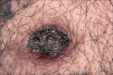 Fig. 24.11, Irritated seborrheic keratosis: the lesion has a characteristic dark coloration and there is surrounding erythema.