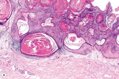 Fig. 24.14, Papillomatous seborrheic keratosis: ( A ) in addition to hyperkeratosis and papillomatosis, horn cysts are conspicuous; ( B ) close-up view.