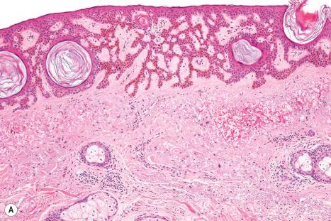 Fig. 24.15, ( A , B ) Adenoid seborrheic keratosis: in this variant much of the tumor is composed of narrow (two-cell thickness), often pigmented trabeculae. Note the hyperpigmentation.