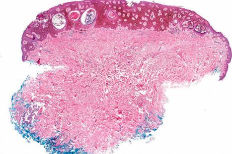 Fig. 24.18, Pigmented seborrheic keratosis: abundant melanin is present in this variant. Some authors classify this lesion as a melanoacanthoma.