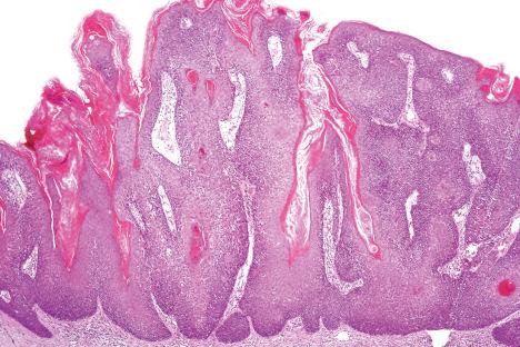 Fig. 24.22, Irritated seborrheic keratosis: low-power view showing pseudohorn cysts, squamous eddies, and patchy chronic inflammation.