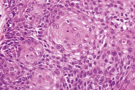 Fig. 24.23, Irritated seborrheic keratosis: high-power view of squamous eddies.