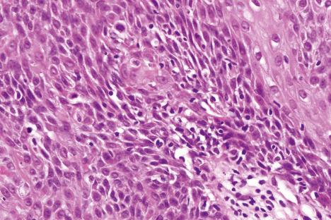 Fig. 24.24, Irritated seborrheic keratosis: there is a light lymphocytic infiltrate with focal spongiosis and exocytosis.