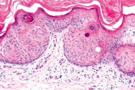 Fig. 24.31, Intraepidermal (Borst-Jadassohn) epithelioma: this example represents a clonal seborrheic keratosis.