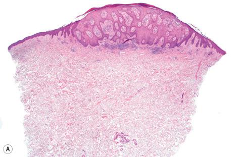 Fig. 24.33, Clear cell acanthoma: ( A ) the lesion, which is sharply demarcated, shows striking hyperplasia; ( B ) although the basal epithelial cells retain their normal tinctorial properties, most of the epithelium shows marked pallor.