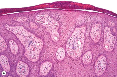 Fig. 24.34, Clear cell acanthoma: ( A ) neutrophils in transit and within the crust on the surface of the lesion are characteristic; ( B ) the keratinocyte pallor is due to massive glycogen deposition as seen in this periodic acid-Schiff reaction.