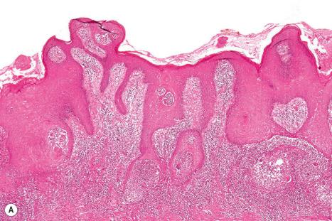 Fig. 24.35, Pseudoepitheliomatous hyperplasia: ( A ) there is very marked irregular acanthosis extending deeply into the reticular dermis. Note the inflammation; ( B ) this is a case of blastomycosis. A yeast form is present in the multinucleate giant cell.