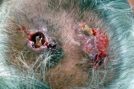 Fig. 24.36, Basal cell carcinoma: multiple ulcerated lesions are present on this patient's scalp.