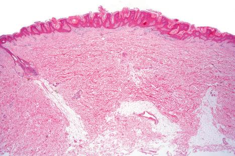 Fig. 24.4, Epidermal nevus: scanning view; note the hyperkeratosis, papillomatosis, and acanthosis.