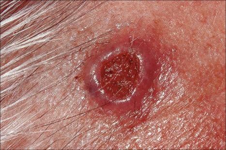 Fig. 24.38, Ulcerative basal cell carcinoma: note the central ulceration and characteristic rolled border.