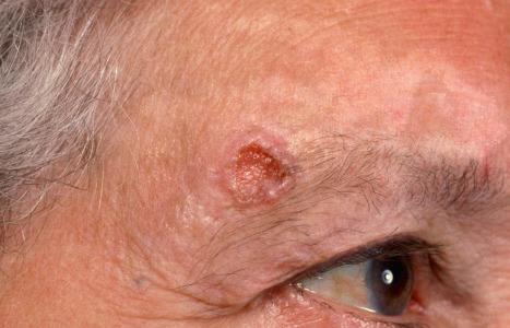 Fig. 24.39, Ulcerative basal cell carcinoma: the rolled border is well developed in this example.