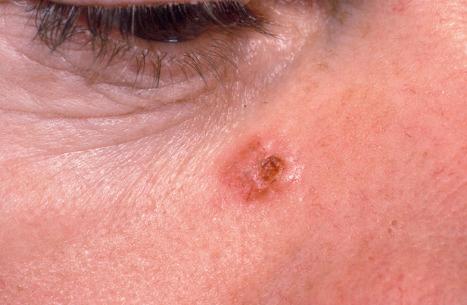 Fig. 24.40, Ulcerative basal cell carcinoma: typical lesion on the upper cheek.