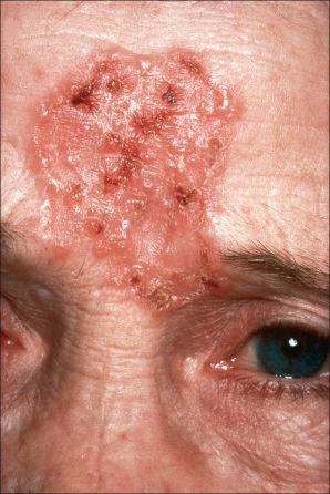 Fig. 24.41, Ulcerative basal cell carcinoma: a rather more extensive lesion showing partial central healing.