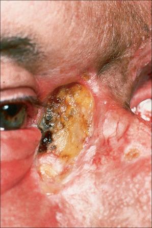 Fig. 24.42, Ulcerative basal cell carcinoma: this example shows very extensive nasal destruction.