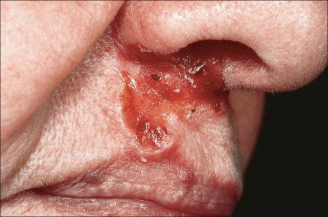 Fig. 24.43, Ulcerative basal cell carcinoma: it is particularly important with this variant to exclude perineural infiltration which in part accounts for the very high recurrence rate.