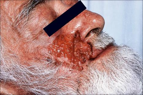 Fig. 24.44, Ulcerative basal cell carcinoma: this patient shows very extensive facial involvement.