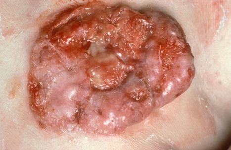 Fig. 24.45, Ulcerative basal cell carcinoma: this is a very large multinodular lesion showing focal ulceration. Lesions as large as this example are uncommon in Western societies.