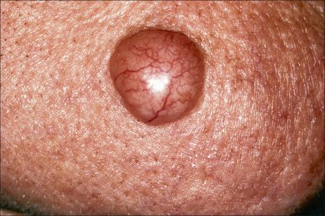 Fig. 24.46, Nodular basal cell carcinoma: note the characteristic telangiectatic vessels coursing over the surface.