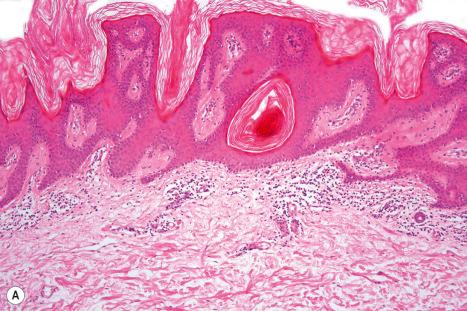 Fig. 24.5, Epidermal nevus: ( A ) medium-power view; ( B ) the features are reminiscent of seborrheic keratosis. Note the keratin-filled pseudocysts. Scattered lymphocytes are present in the superficial dermis.