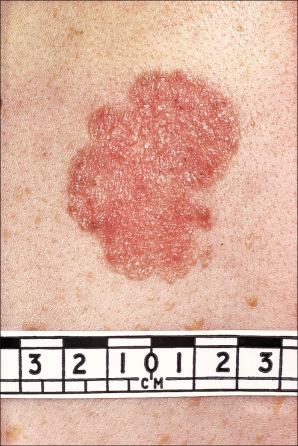 Fig. 24.48, Superficial basal cell carcinoma: note the erythema and scaling. This variant may be clinically mistaken for eczema or psoriasis. It is notoriously difficult to identify the radial border of this lesion.