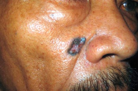 Fig. 24.49, Pigmented basal cell carcinoma: the pigmented nature of this variant sometimes causes clinical confusion with malignant melanoma.