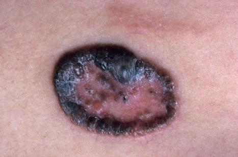 Fig. 24.50, Pigmented basal cell carcinoma: this extensively pigmented example could easily be mistaken for a melanoma with central regression.