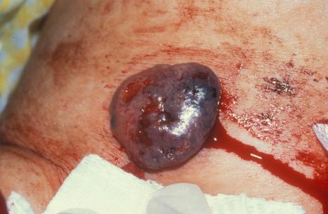 Fig. 24.51, Pigmented basal cell carcinoma: this is an unusually large nodular pigmented variant.