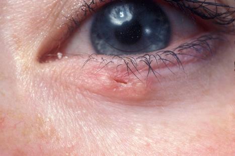 Fig. 24.53, Basal cell carcinoma: tumors involving the periocular tissues are notoriously difficult to treat and have a high recurrence rate.