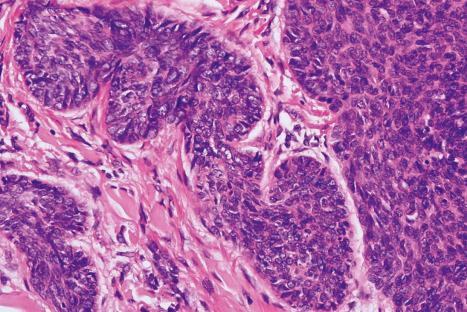 Fig. 24.55, Basal cell carcinoma: the tumor cells have indistinct cytoplasmic borders and oval basophilic vesicular nuclei. Note the retraction artifact.