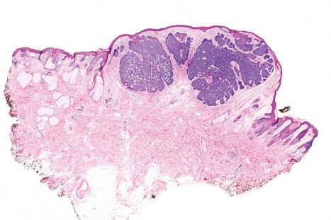 Fig. 24.58, Nodular basal cell carcinoma: scanning view of a typical lesion from the eyelid.