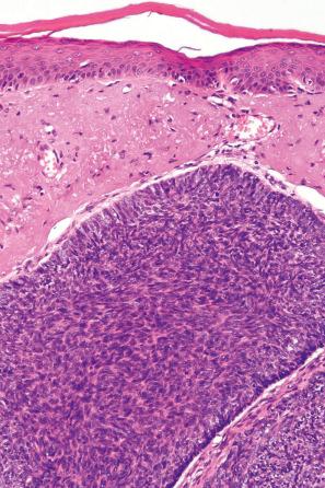 Fig. 24.60, Nodular basal cell carcinoma: marked solar elastosis is present. Note the peripheral palisading.