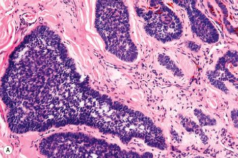 Fig. 24.61, Nodular basal cell carcinoma: ( A ) a peripheral palisade is typically present; ( B ) the retraction artifact as seen in this field is a characteristic feature.