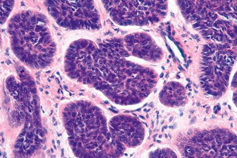 Fig. 24.62, Nodular basal cell carcinoma: high-power view showing the retraction artifact.