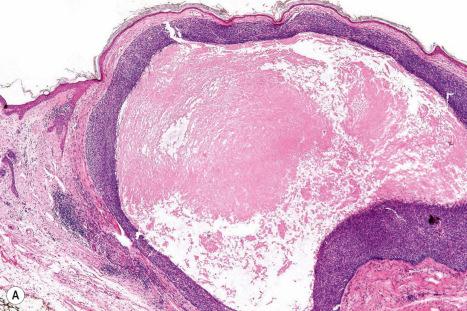 Fig. 24.63, Nodulocystic basal cell carcinoma: ( A ) scanning view of a typical lesion; ( B ) the cysts contain abundant stromal mucin.