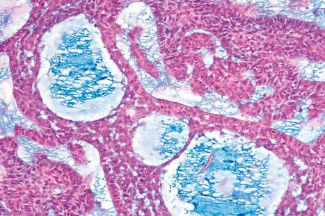 Fig. 24.64, Nodulocystic basal cell carcinoma: the mucin is Alcian blue (pH 2.5) positive.