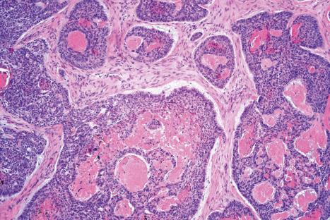 Fig. 24.65, Basal cell carcinoma: amyloid deposits as seen in this field are common. Their presence is of no clinical significance.