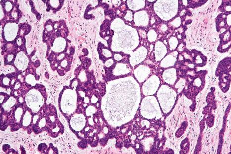 Fig. 24.66, Adenoid basal cell carcinoma: this pseudoglandular appearance is characteristic.