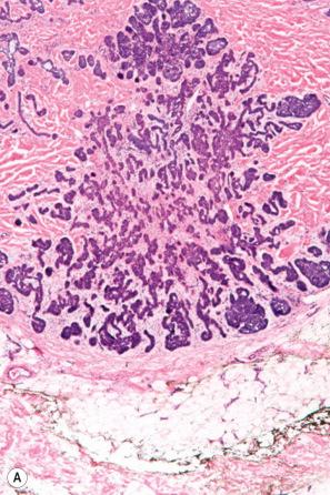 Fig. 24.67, Micronodular basal cell carcinoma: ( A ) low-power view showing the small size and relative uniformity of the tumor nodules; ( B ) absence of a retraction artifact is typical of this variant. Brisk mitotic activity and apoptosis aid in distinction from trichoepithelioma.