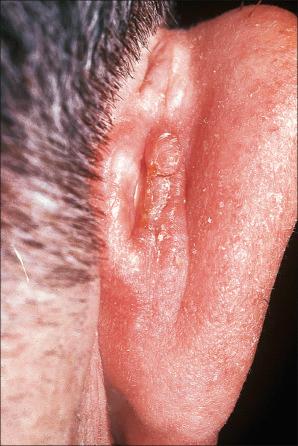 Fig. 24.7, Spectacle frame acanthoma: a ‘tumor’ behind the ear of a middle-aged male. Note the characteristic central groove or furrow.