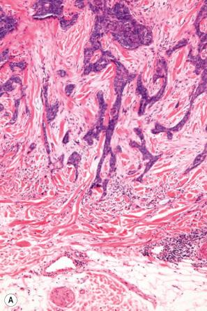 Fig. 24.69, Infiltrative basal cell carcinoma: ( A ) the tumor cells are present as narrow strands surrounded by a mucin-rich stroma; ( B ) close-up view.