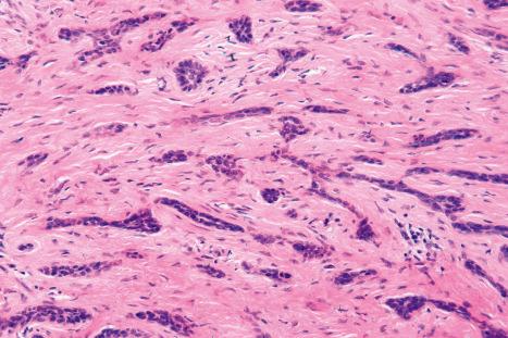 Fig. 24.70, Morpheaform basal cell carcinoma: this variant is characterized by narrow epithelial strands compressed by a dense fibrous stroma. Mucin is absent.