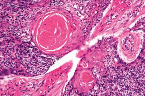 Fig. 24.71, Keratotic basal cell carcinoma: this rare variant is characterized by the presence of keratocysts.