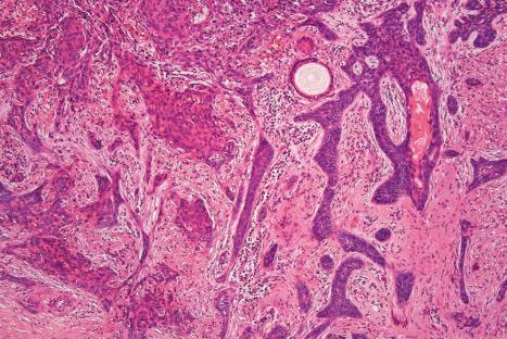 Fig. 24.72, Metatypical basal cell carcinoma: on the left side of the field the features are those of squamous differentiation.