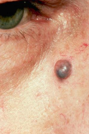 Fig. 33.1, Apocrine hidrocystoma: this shows a characteristic bluish translucent swelling on the cheek of a middle-aged male patient.