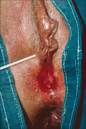 Fig. 33.11, Hidradenoma papilliferum: this example has caused erythema and ulceration below the right labium minus and around the introitus.